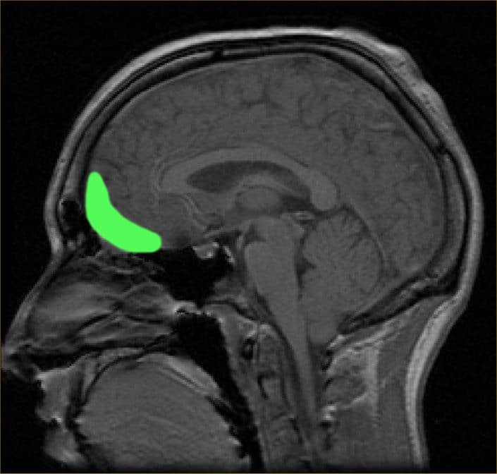 MRI of orbitofrontal cortex PaulWicks Public domain via Wikimedia Commons 1